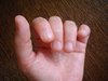 bited nails